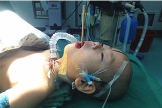 男童在幼儿园被筷子插入鼻子致穿孔